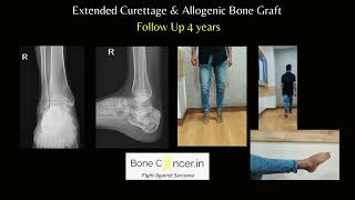 Treatment for Bone Cyst Aneurysmal Calcaneus in AdultCurettage and Bone Grafting Dr Srimanth BS [upl. by Eenar]