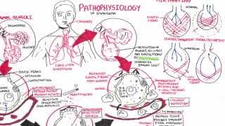 Emphysema  Pathophysiology COPD [upl. by Connett]