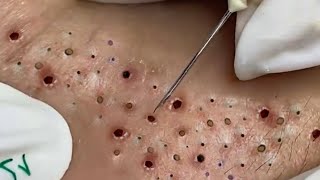 Big Cystic Acne Blackheads Extraction Blackheads amp Milia Whiteheads Removal Pimple Popping  8139 [upl. by Earla]