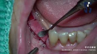 Apically repositioned flap  APF with xenogenic soft tissue graft [upl. by Gillian217]