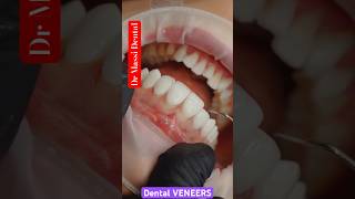 Smile Transformation with Veneers A Cosmetic Dentistry Breakthrough [upl. by Gonroff]