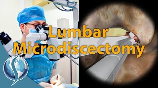 Lumbar Microdiscectomy [upl. by Ellertal]