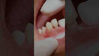 Zirconia crowns dentistry [upl. by Uriel]