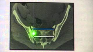 Part 2 Pubic Joint Dysfunction amp Symphyseal Diastasis  Hesch Institute [upl. by Colette]