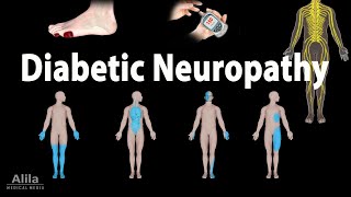 Diabetic Neuropathy Animation [upl. by Ayitahs]