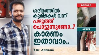 Bullous Eruptions on Skin benign Pemphigus Hailey Hailey Disease Malayalam  Dr Abhiram VK [upl. by Kirima]