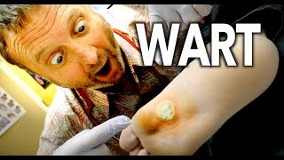 WORLDS LARGEST WART Frozen With Liquid Nitrogen  Dr Paul [upl. by Keifer]