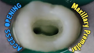 access opening of maxillary first premolar  step by step demonstration [upl. by Yenruoj]