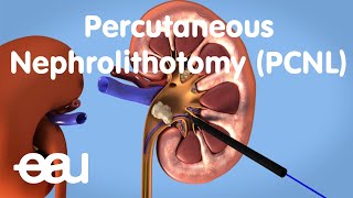 Removal of kidney stones PCNL [upl. by Etnovahs]