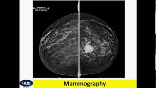 Invasive ductal carcinoma breast cancer [upl. by Haniraz571]