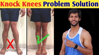 How To Fix Knock Knees at Home  Knock knee Problem solution [upl. by Ennairb]