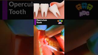 Operculum wisdom tooth treatment dentist dentistry wisdomtooth shortsfeed [upl. by Hildick]