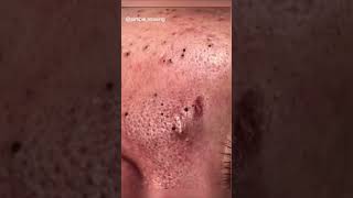 Blackheads Removal  Acne Treatment and Very Satisfying Satisfying Pimple pop blackheads [upl. by Laurens]