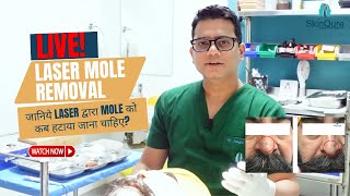 Live Mole Removal by Laser  Best Mole removal in Delhi  SkinQure  Dr Jangid [upl. by Haven]