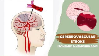 Cerebrovascular accident or stroke  Ischemic and hemorrhagic [upl. by Ikcin]