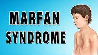 Marfan Syndrome [upl. by Adnocahs53]