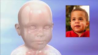 What is Hunter syndrome MPS II [upl. by Athiste938]