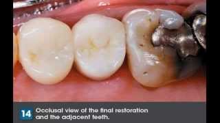 How to Adjust and Polish FullContour Zirconia Crowns [upl. by Alyaj]