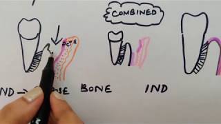 Periodontal flap part 1 carranza chap57 [upl. by Latsryc]