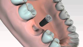 Chirurgie 3D Implant Thommen [upl. by Annabel724]