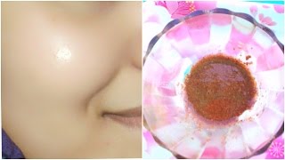 How To Remove Acne Pimples Overnight 100 Works 5 Home Remedies  Acne Scar Treatment [upl. by Ennaoj]