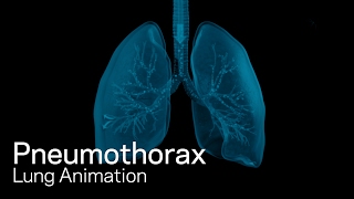 Pneumothorax [upl. by Cissie552]