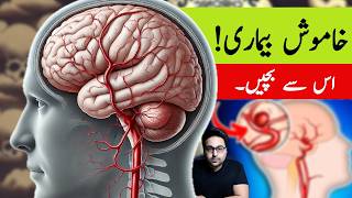 Dr ZeeAneurysm A Silent Killer  डॉक्टर ज़ी [upl. by Haret]