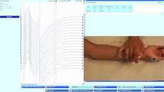 Ulnaire moteurMuscle abductor digiti minimi neurographie motrice avec ondes F [upl. by Ayalat]