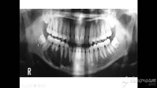 radiographic features of ameloblastoma [upl. by Aihsa]