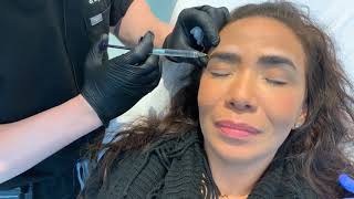 Brow Lift Using Fillers  Restalyne Defyne for Brows  West Hollywood CA  Dr Jason Emer [upl. by Jeromy]