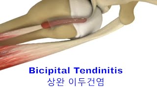 Bicipital Tendinitis What It Is And How To Treat It 상완이두건염 [upl. by Marlie788]