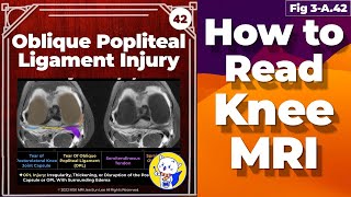 Fig 3A42 Oblique Popliteal Ligament Injury [upl. by Asiul]