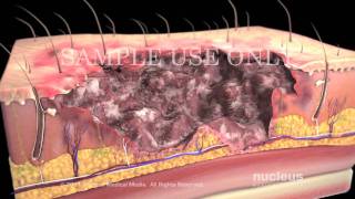 Burns Classification and Treatment [upl. by Nahshu339]