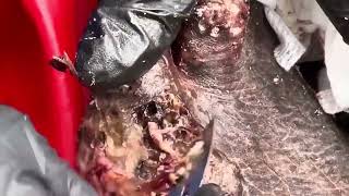 Jigger removal chigger removal sandflea removal satisfying cyst and boil popping compilation [upl. by Dranrev649]