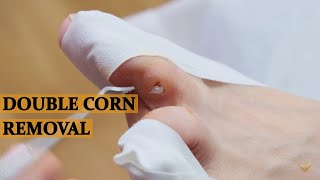 DEEP SATISFYING CORN REMOVAL [upl. by Treblah690]