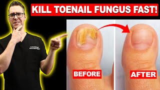 Tips to Treat Nail Fungus at Home [upl. by Mell]