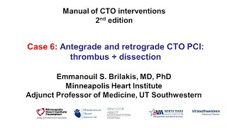 Case 6 Manual of CTO Interventions  OCT for thrombus and dissection [upl. by Aytac]