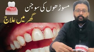 Gums Swelling and Bleeding Treatment at Home without going to a Dentist [upl. by Llezom608]