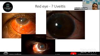 Anterior Uveitis Case Based LiveStream Lecture Series LetsGetonwithExams [upl. by Araas]