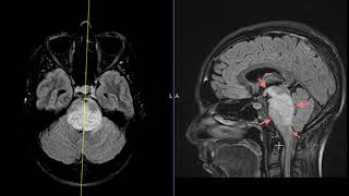 Diplopia vertigo and nystagmus in 34 year old [upl. by Aissat628]