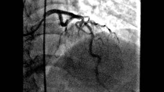 Corazón cateterismo stent [upl. by Orfurd]