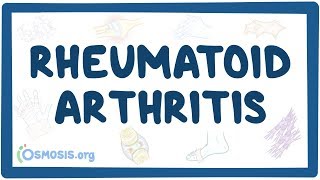 Rheumatoid arthritis  causes symptoms diagnosis treatment pathology [upl. by Aibar]