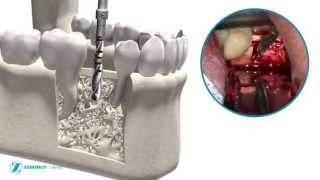 Zimmer Trabecular Metal Dental Implant  MDEA 2013 Silver Winner [upl. by Finbar495]