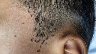 How to remove all lice from short hair  Getting out all of lice from his head [upl. by Sirdi]