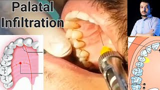 Local Anesthesia Palatal Infiltration Technique Maxillary Anesthesia Techniques dentistry [upl. by Amikan]