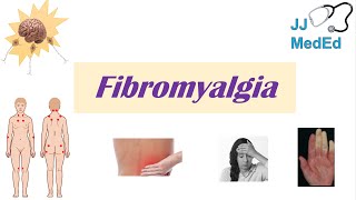 003 What is Fibromyalgia [upl. by Ymmaj171]