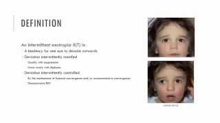 Intermittent Exotropia Characteristics [upl. by Eiramave961]