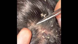 Picking and combing through dandruff psoriasis scalp scratching flare up [upl. by Sarilda]