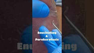 Enucleating A Porokeratosis [upl. by Housum254]