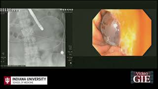 Endoscopic management of acute buried bumper syndrome [upl. by Sucramraj]